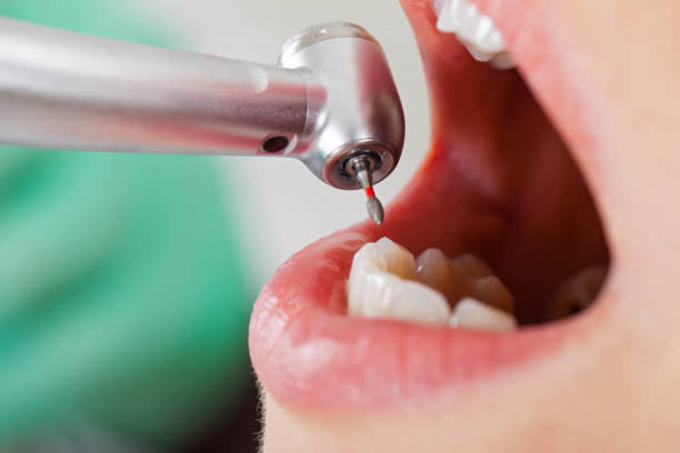 Best Emergency Root Canal Treatment in Burbank, IL